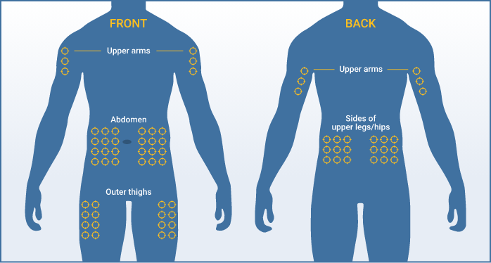 Infusion sites